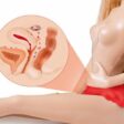 endometriose