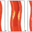 arteriosclerose