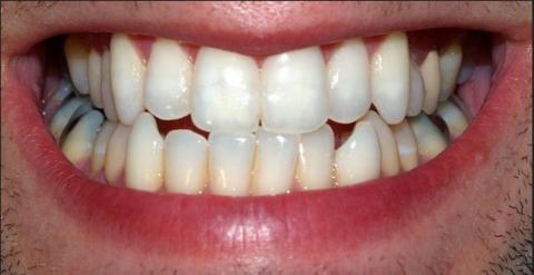 Receita de clareamento dental caseiro