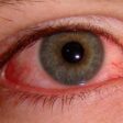 Glaucoma - dicas