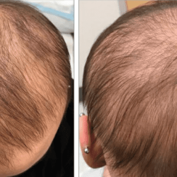 Cura da calvície - homem careca