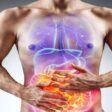 síndrome do intestino irritável