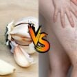 Alho vs. Varizes: combata as varizes usando essa poderosa planta